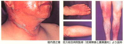 農薬による皮膚障害